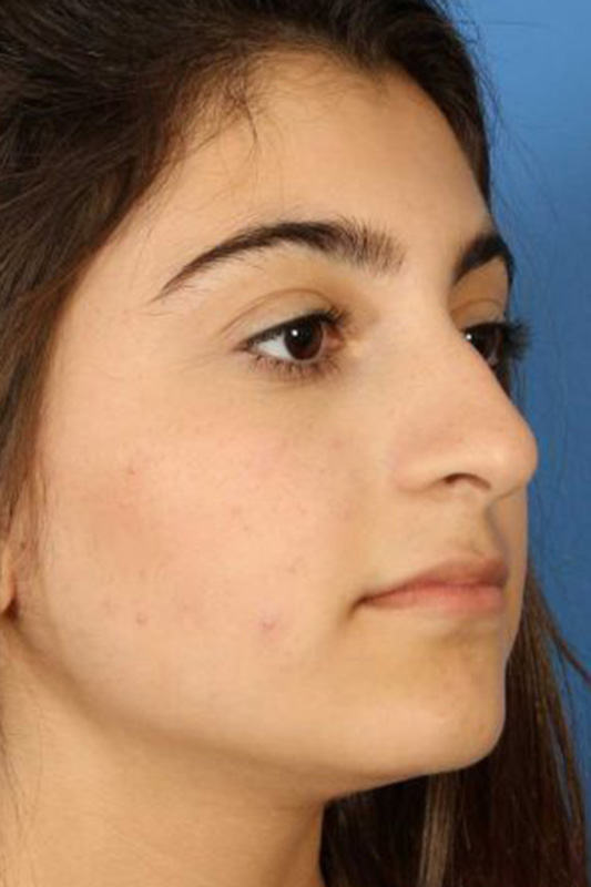 Rhinoplasty Before & After Photo