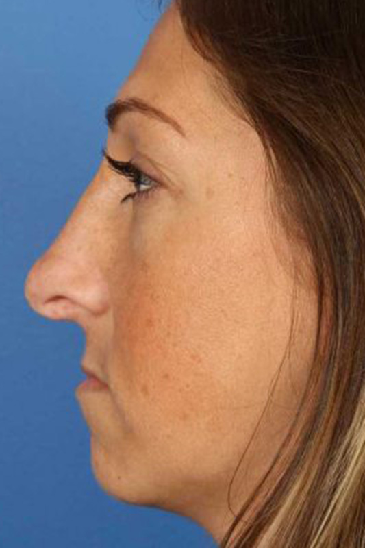 Rhinoplasty Before & After Photo