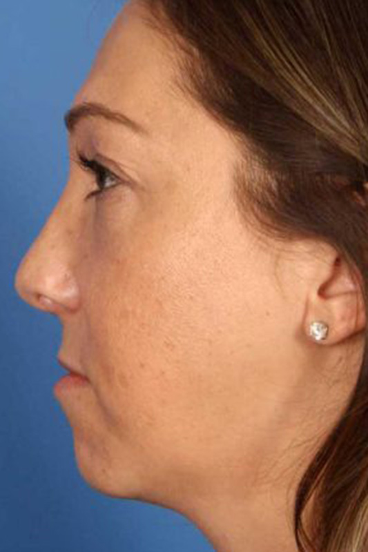 Rhinoplasty Before & After Photo