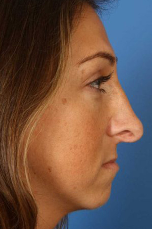 Rhinoplasty Before & After Photo