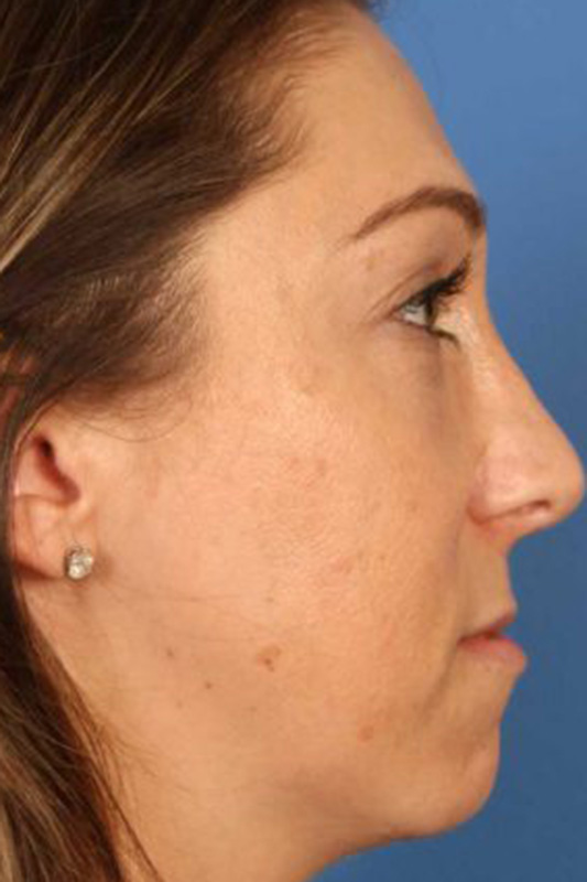 Rhinoplasty Before & After Photo