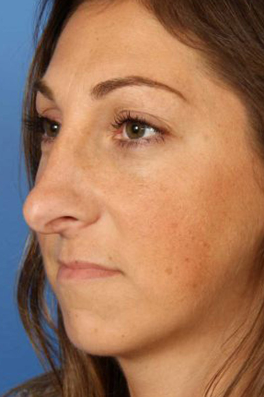 Rhinoplasty Before & After Photo