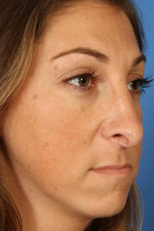 Rhinoplasty Before & After Photo