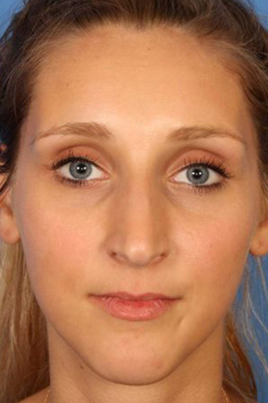 Rhinoplasty Before & After Photo