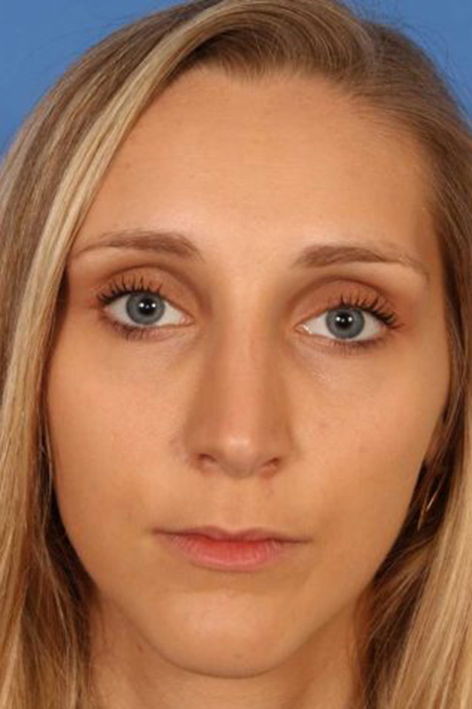 Rhinoplasty Before & After Photo