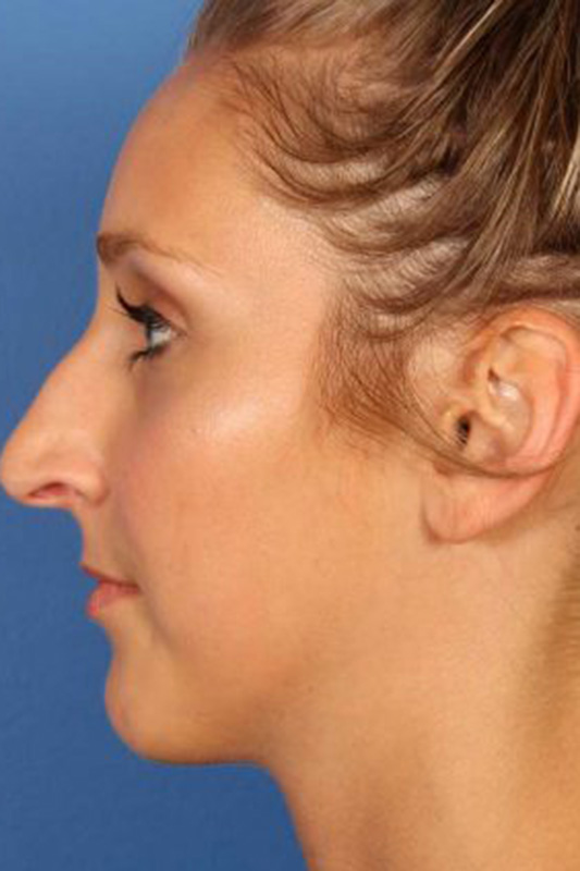 Rhinoplasty Before & After Photo