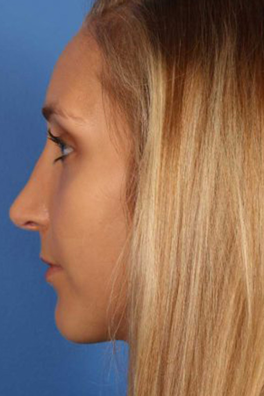 Rhinoplasty Before & After Photo