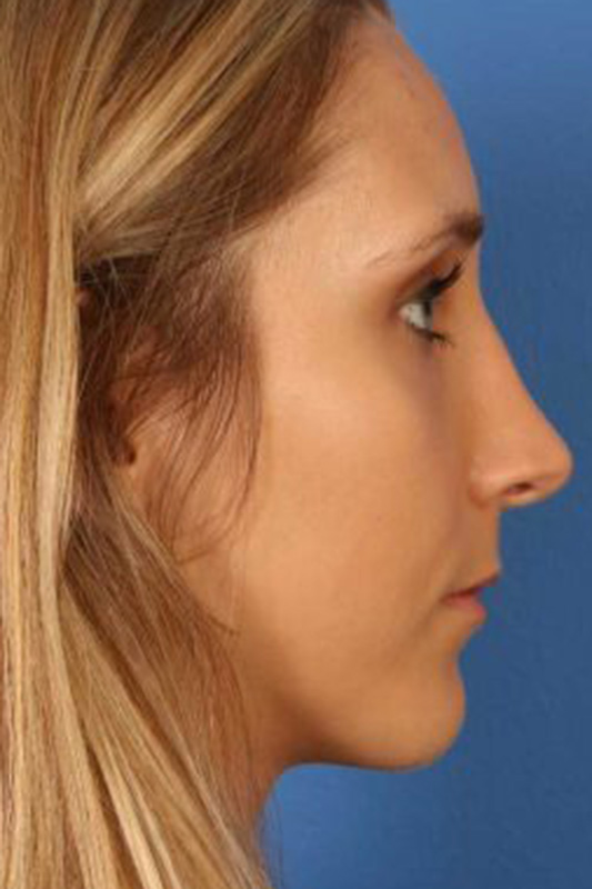 Rhinoplasty Before & After Photo