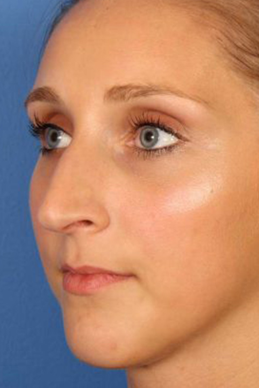 Rhinoplasty Before & After Photo