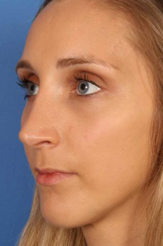 Rhinoplasty Before & After Photo