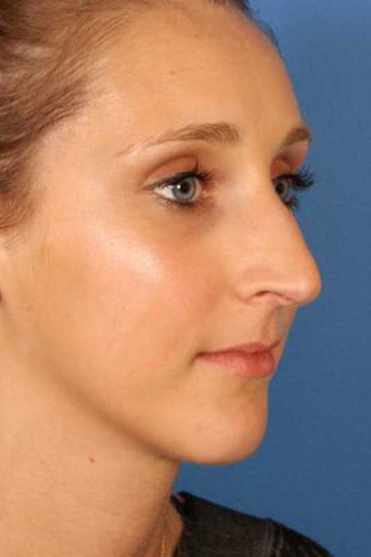 Rhinoplasty Before & After Photo