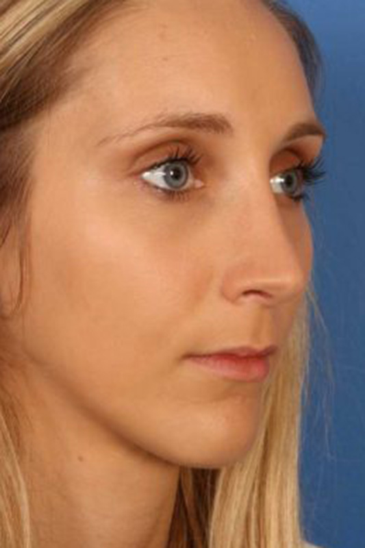 Rhinoplasty Before & After Photo