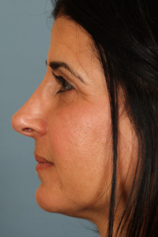 Rhinoplasty Before & After Photo