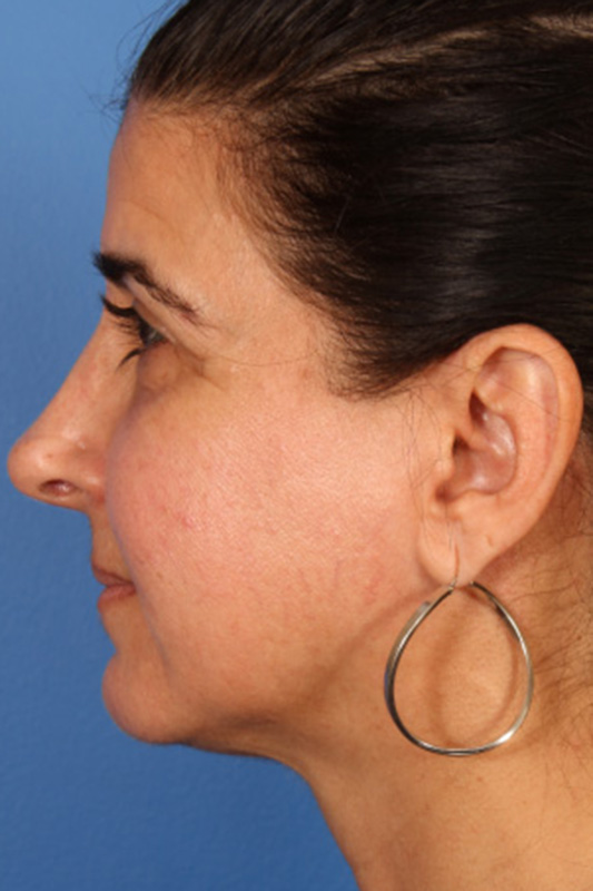 Rhinoplasty Before & After Photo