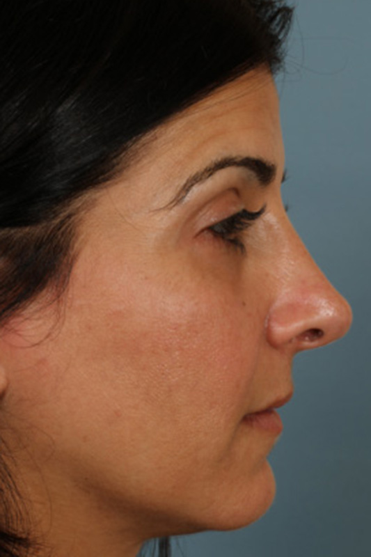 Rhinoplasty Before & After Photo