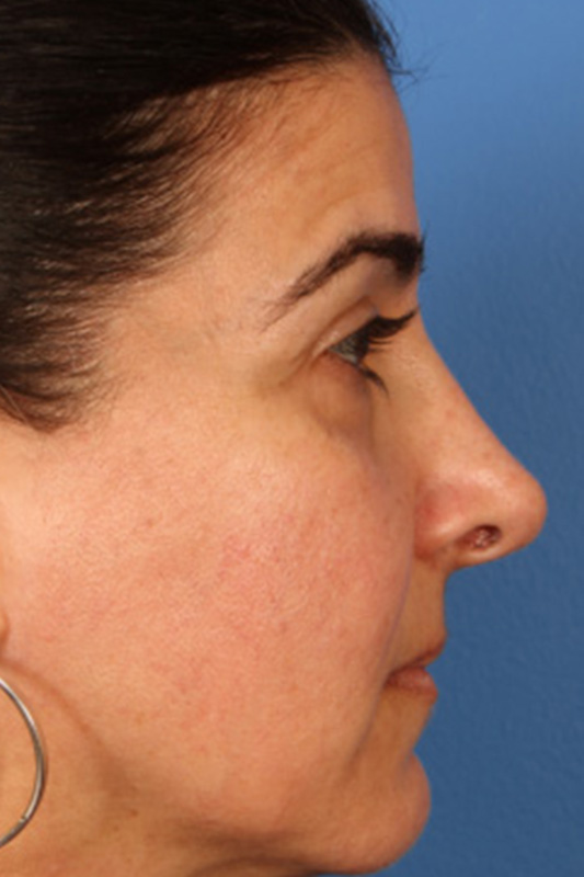 Rhinoplasty Before & After Photo