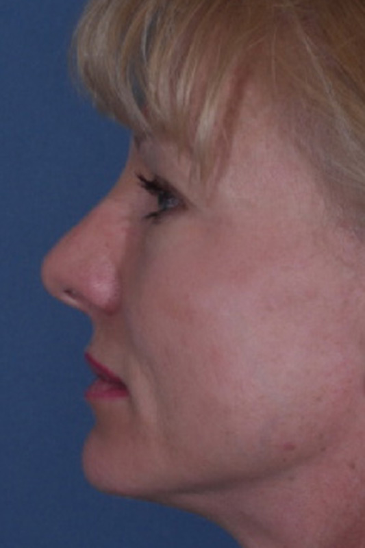 Rhinoplasty Before & After Photo