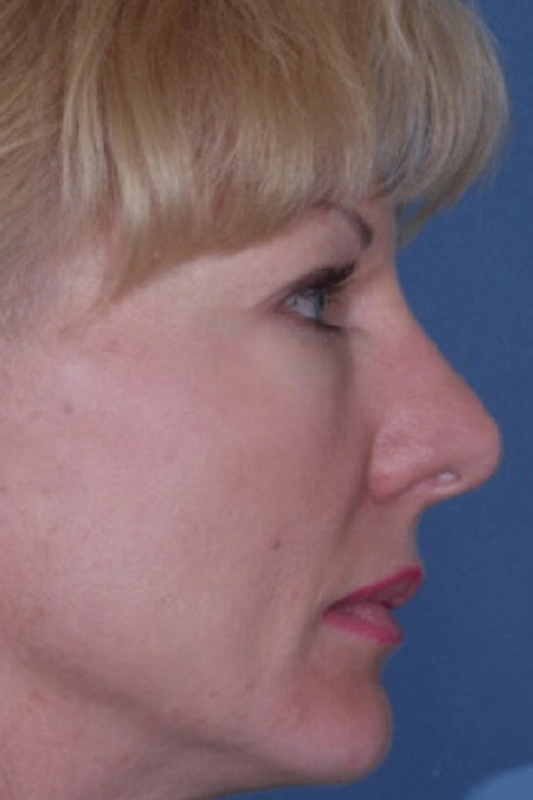 Rhinoplasty Before & After Photo