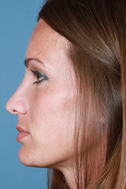 Rhinoplasty Before & After Photo