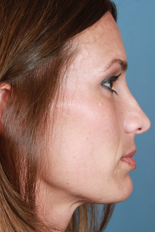 Rhinoplasty Before & After Photo