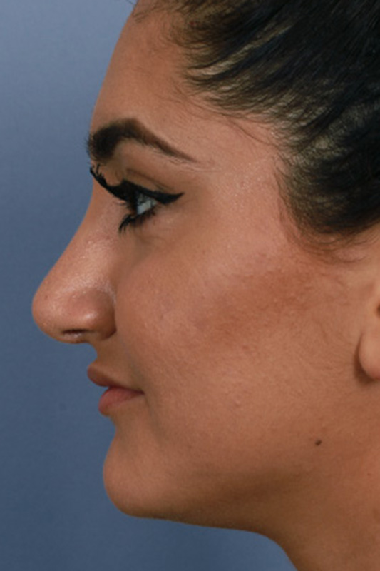 Rhinoplasty Before & After Photo