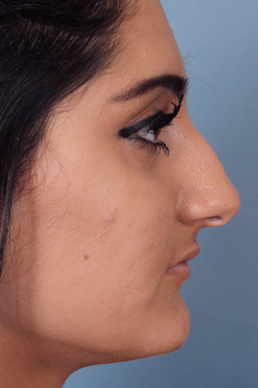 Rhinoplasty Before & After Photo