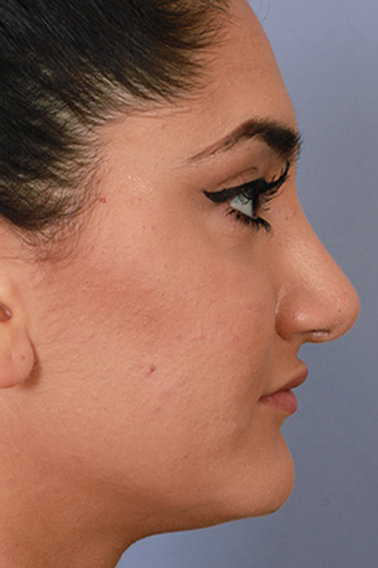 Rhinoplasty Before & After Photo