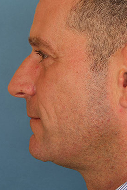 Rhinoplasty Before & After Photo