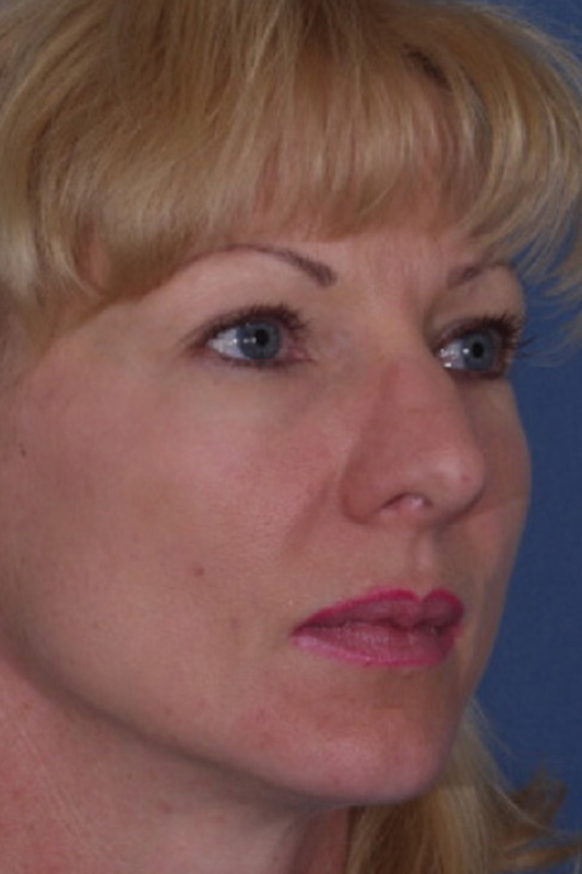 Rhinoplasty Before & After Photo