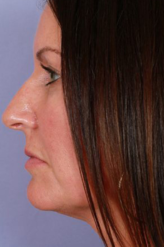 Rhinoplasty Before & After Photo