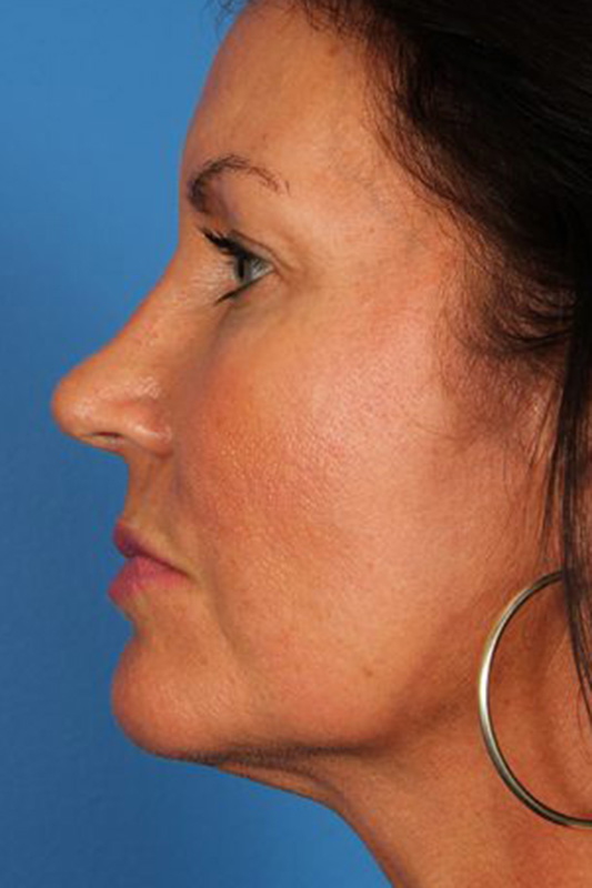 Rhinoplasty Before & After Photo