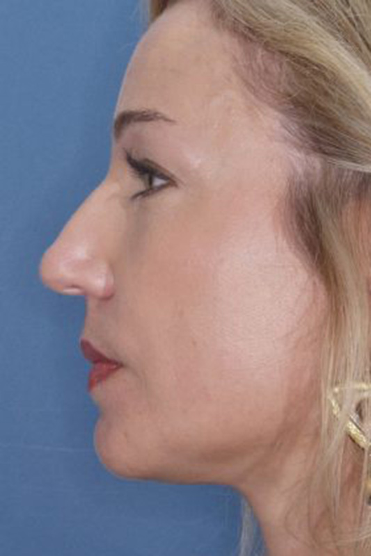 Rhinoplasty Before & After Photo