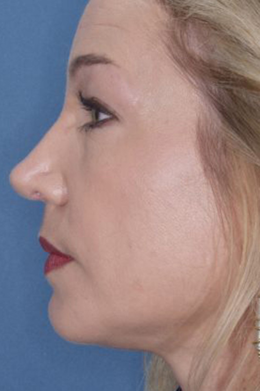 Rhinoplasty Before & After Photo