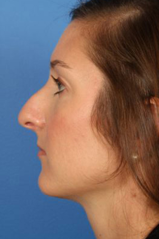 Rhinoplasty Before & After Photo