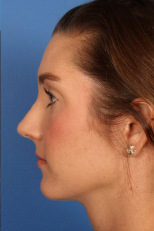 Rhinoplasty Before & After Photo