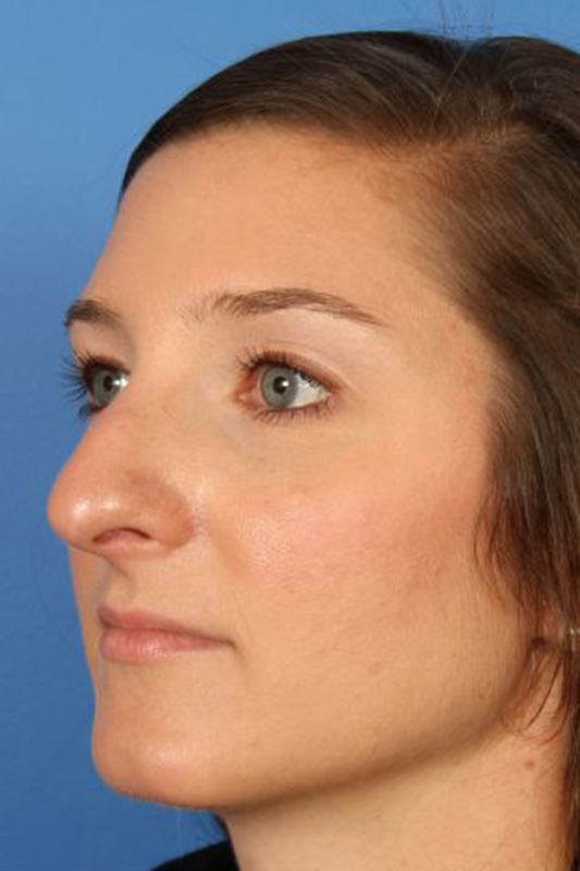 Rhinoplasty Before & After Photo