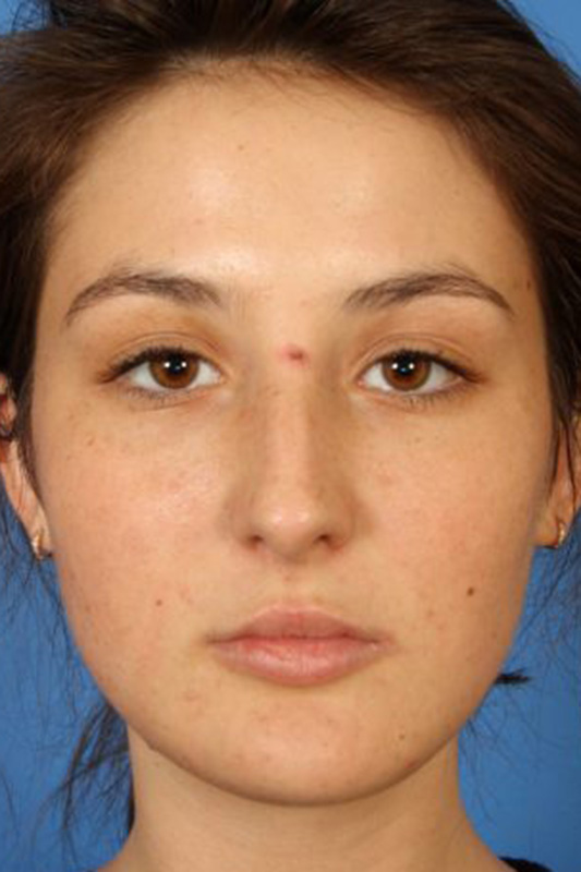 Rhinoplasty Before & After Photo