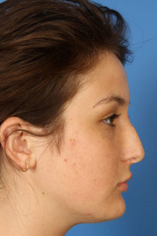 Rhinoplasty Before & After Photo