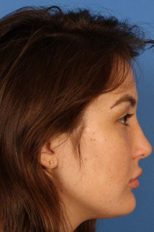 Rhinoplasty Before & After Photo