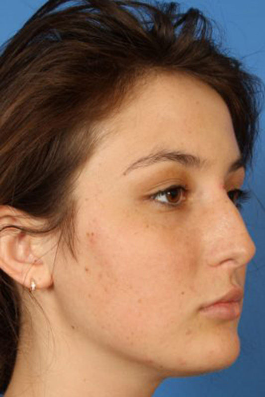 Rhinoplasty Before & After Photo