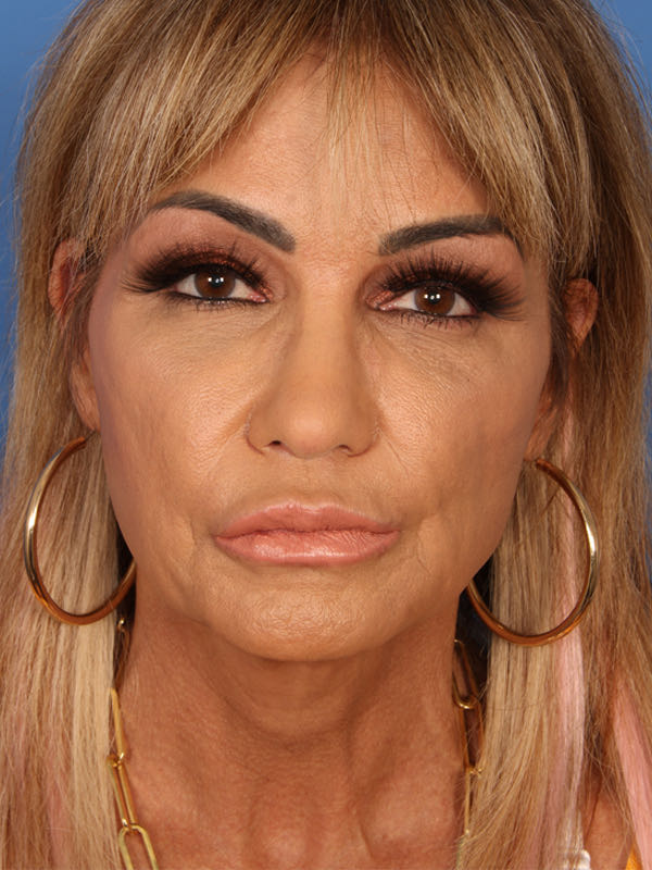 Upper Blepharoplasty Before & After Photo