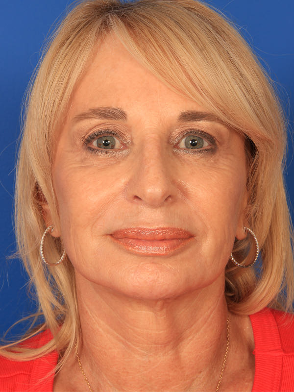 Upper Blepharoplasty Before & After Photo