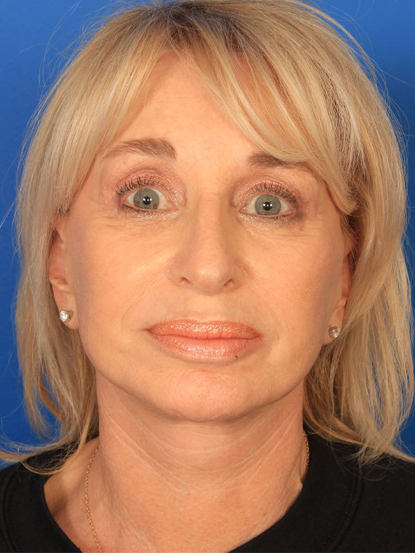 Upper Blepharoplasty Before & After Photo