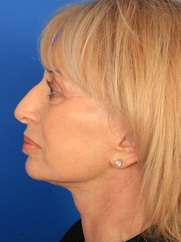 Upper Blepharoplasty Before & After Photo
