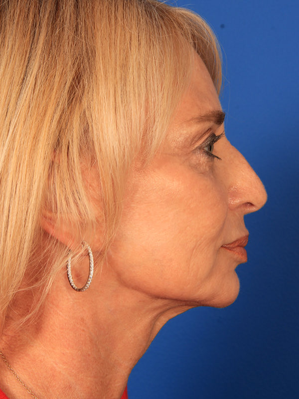 Upper Blepharoplasty Before & After Photo