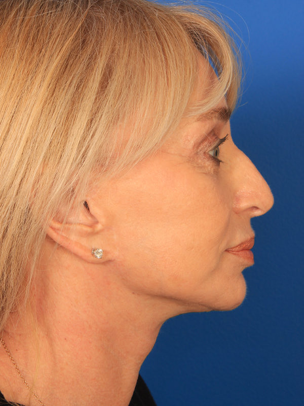 Upper Blepharoplasty Before & After Photo